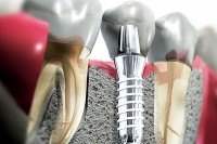 implantaciya-zubov-v-krasnodare