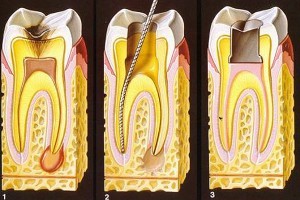 Эндодонтия, лечение каналов зубов